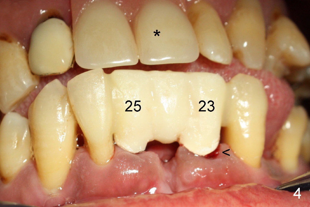 Immediate Implantsupported Bridge, Duluth, GA Dentist Dental Education